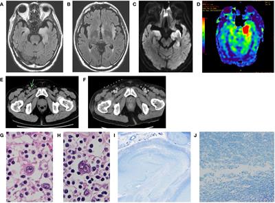 Case Report: Anti-mGluR5 antibody-negative Ophelia syndrome with failed lymph node biopsy due to steroid therapy